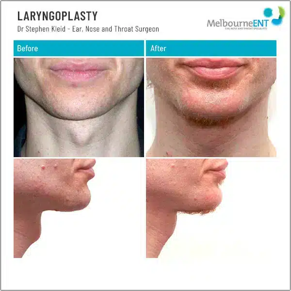 Laryngoplasty Before and After Laryngoplasty Before and After