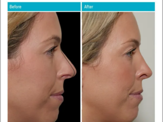 Plan Line Before and After Rhinoplasty