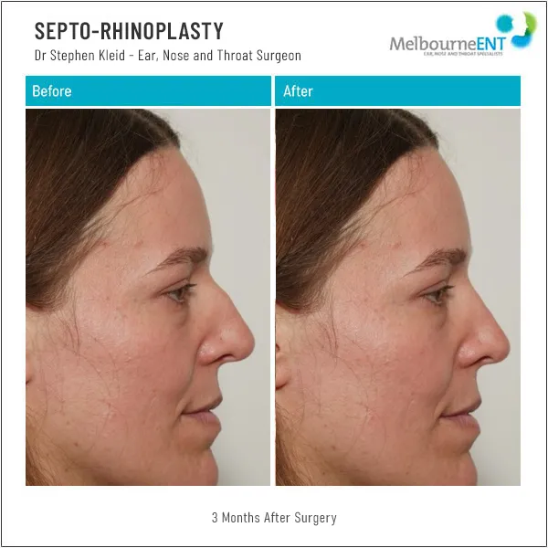 Septo-Rhinoplasty 3 Months After Surgery Before and After Septo-Rhinoplasty 3 Months After Surgery Before and After