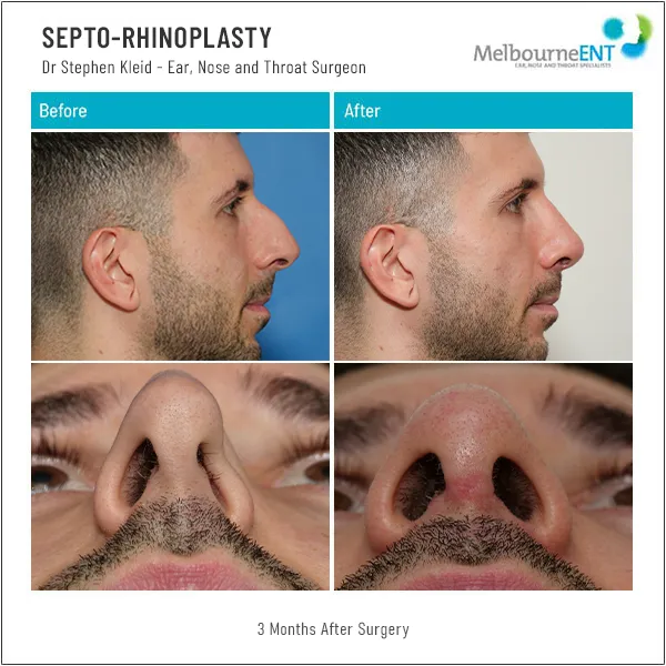 Septo-Rhinoplasty Before and After Septo-Rhinoplasty Patient 0008 4 Grid
