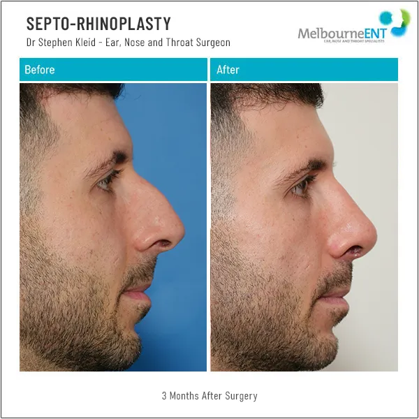 Septo-Rhinoplasty Before and After Septo-Rhinoplasty Before and After