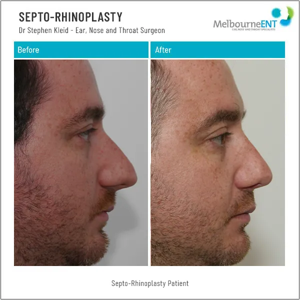 Septo-Rhinoplasty Before and After Septo-Rhinoplasty Before and After