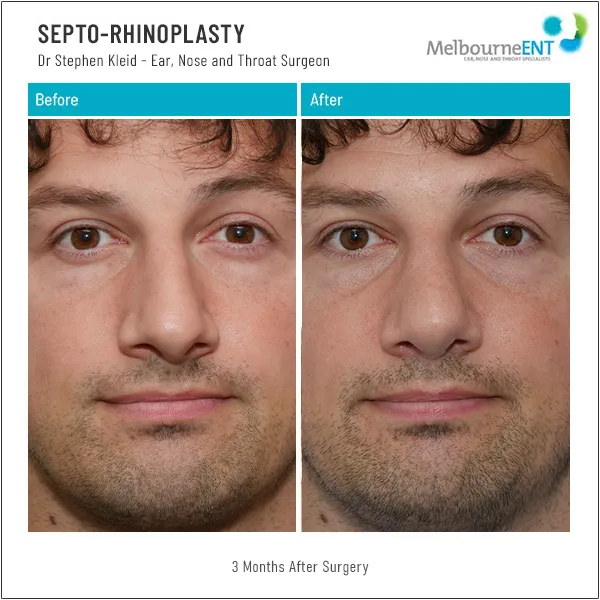 Septo Rhinoplasty 3 Months After Surgery Septo Rhinoplasty 3 Months After Surgery