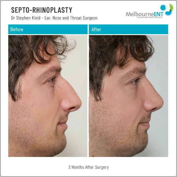 Septo-Rhinoplasty 3 Months After Surgery Septo-Rhinoplasty 3 Months After Surgery