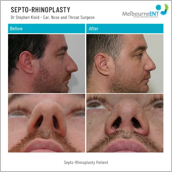 Septo-Rhinoplasty Before and After Septo-Rhinoplasty Before and After
