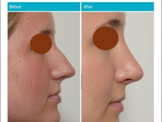 Before and After Rhinoplasty