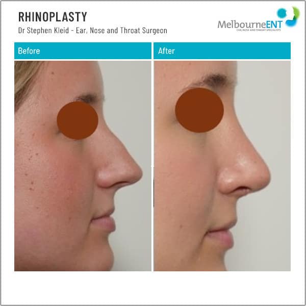 Before and After Rhinoplasty