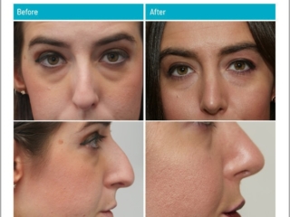 Before and After Rhinoplasty
