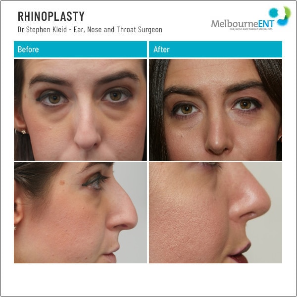 Before and After Rhinoplasty