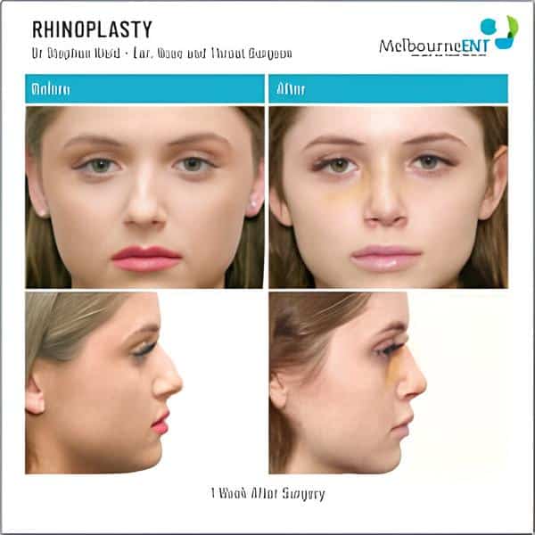 dr-stephen-kleid-rhinoplasty-12-1-600&times;600-1