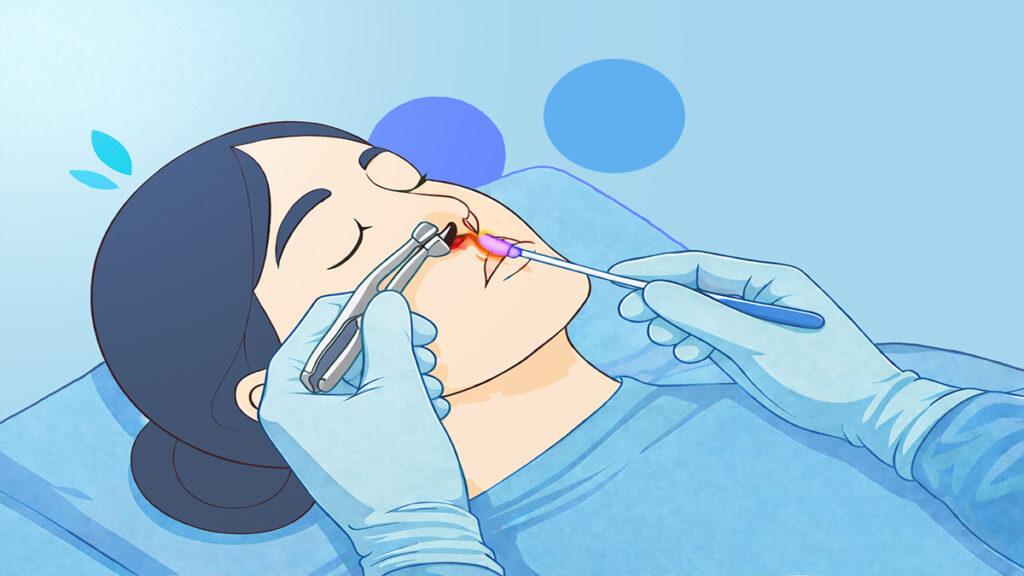 Nasal Cautery Surgery Featured Image - Melbourne ENT