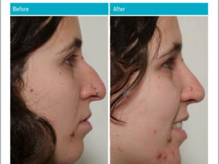Rhinoplasty Hump Removal