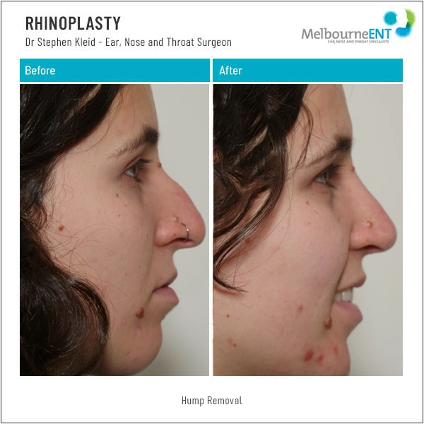 Rhinoplasty Hump Removal