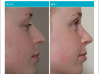 Before and After Rhinoplasty