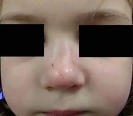 Fractured Nose Image Simon Braham