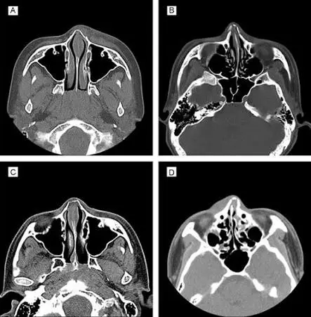 Fractured Nose Imaging Result Simon Braham