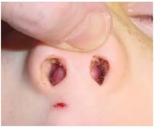 Paediatric Nasal Fracture Simon Braham
