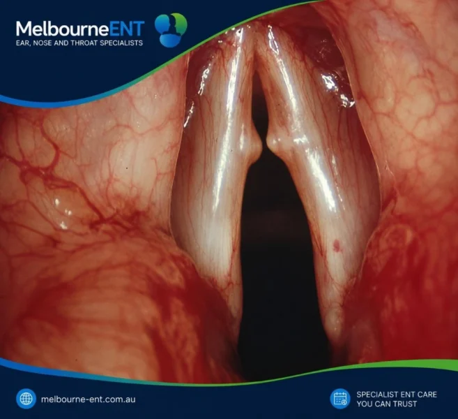 Vocal cords viewed during microlaryngoscopy