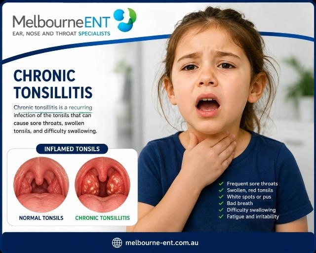 Chronic Tonsillitis Infographics by Dr Braham