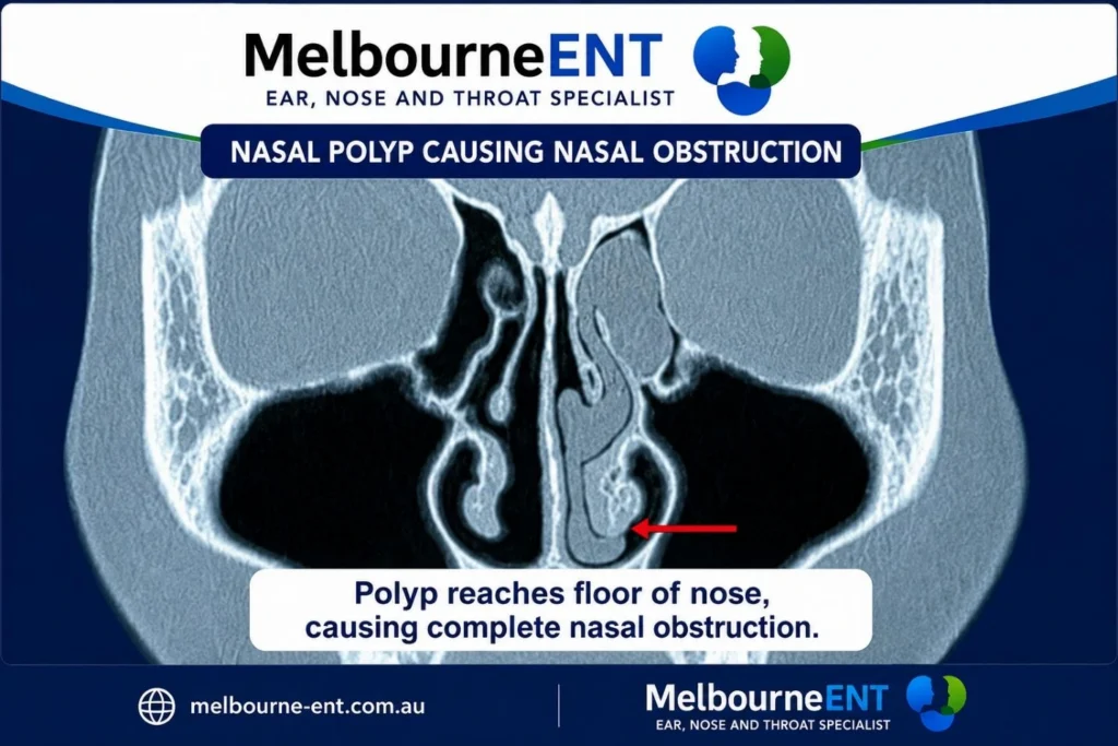 Nasal Polyp Causing Nasal Obstruction - Nose Surgery Image