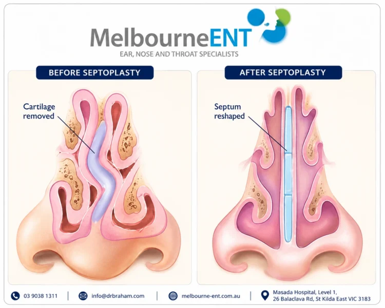 Septoplasty Before and After Diagram Septoplasty Before and After Diagram - Nose Surgery Image