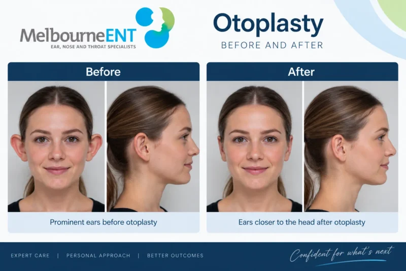adult otoplasty