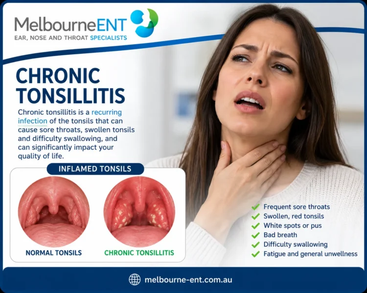 Chronic tonsillitis symptoms and inflamed tonsils