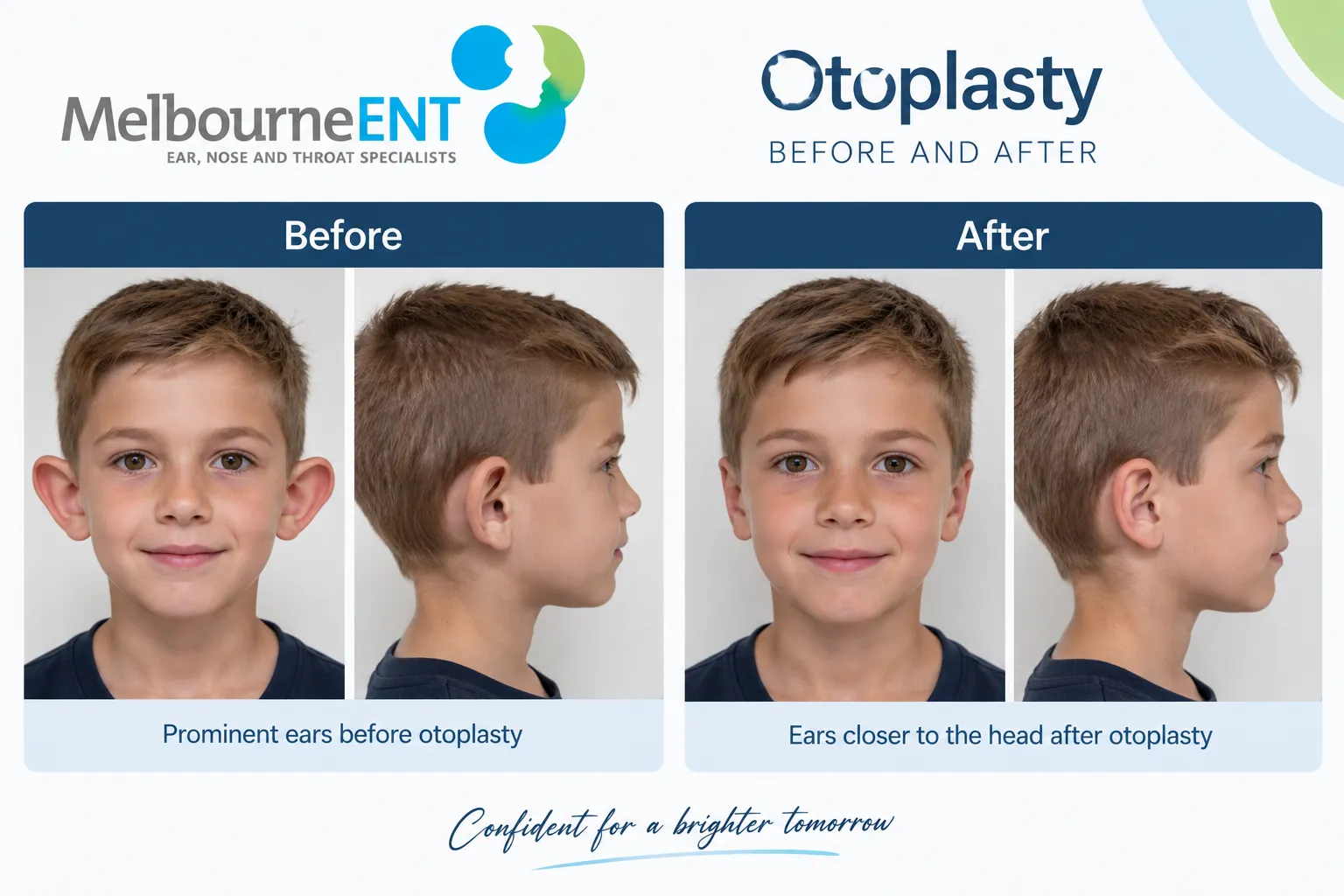 Child before and after otoplasty for prominent ears