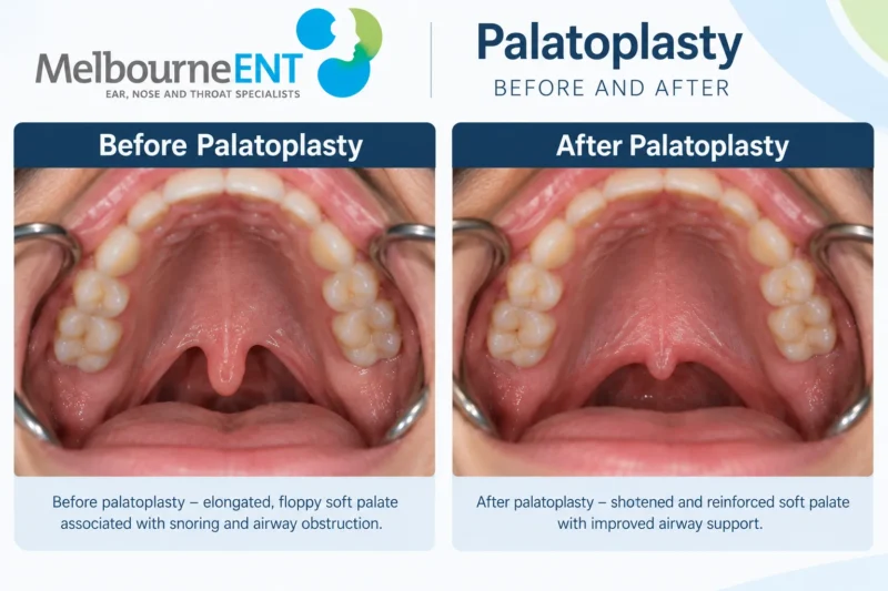Soft palate before and after palatoplasty surgery