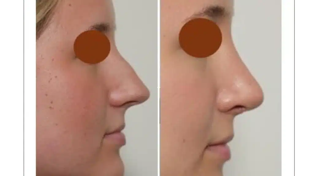 How Long Do Results Last After Functional Rhinoplasty Featured Image - Rhinoplasty Before After Image