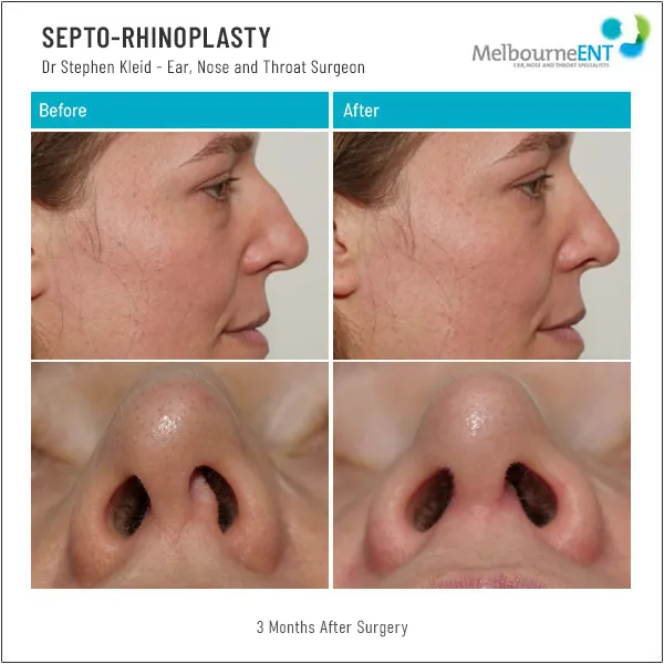 Septo-Rhinoplasty 3 Months After Surgery Before and After Septo-Rhinoplasty 3 Months After Surgery Before and After